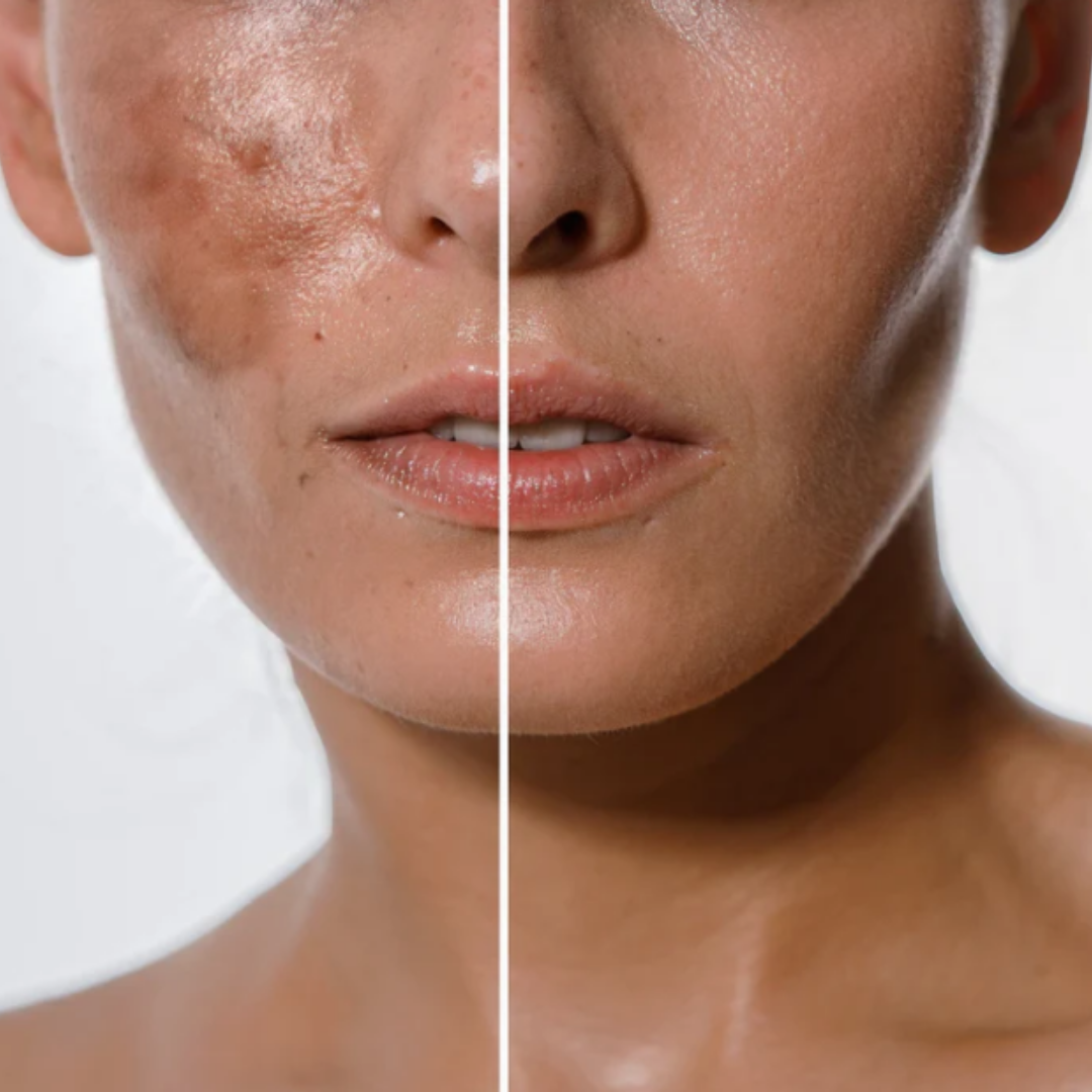 Serum Acido Glicólico (Quita-Manchas)